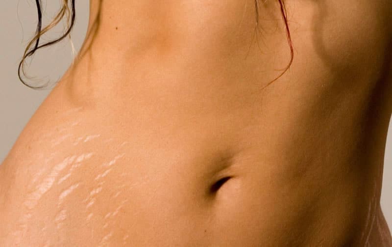 Réduire l'apparence des vergetures sur le ventre après la grossesse